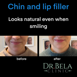 chin and lip fillers during smiling