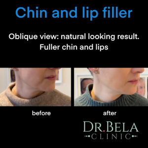chin and lip filler oblique view