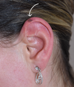 melanoma on the ear