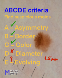 Melanoma ABCDE rule