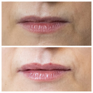 Lip filler before straight after