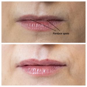 Lip filler before after with Fordyce spots