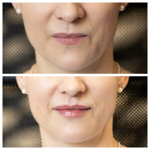Lip filler before straight after