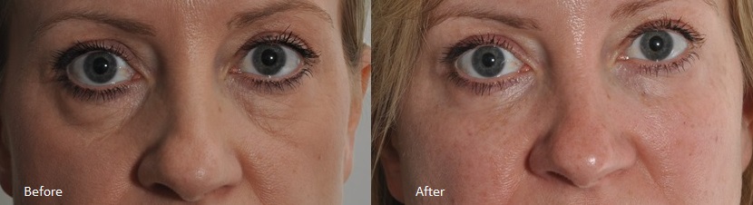 Before and After - Tear trough filler treatment