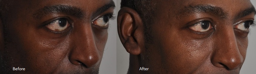 Cheek dermal filler male