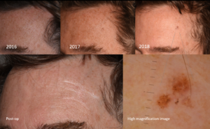 Development of an early-stage melanoma - Dr Bela Clinic