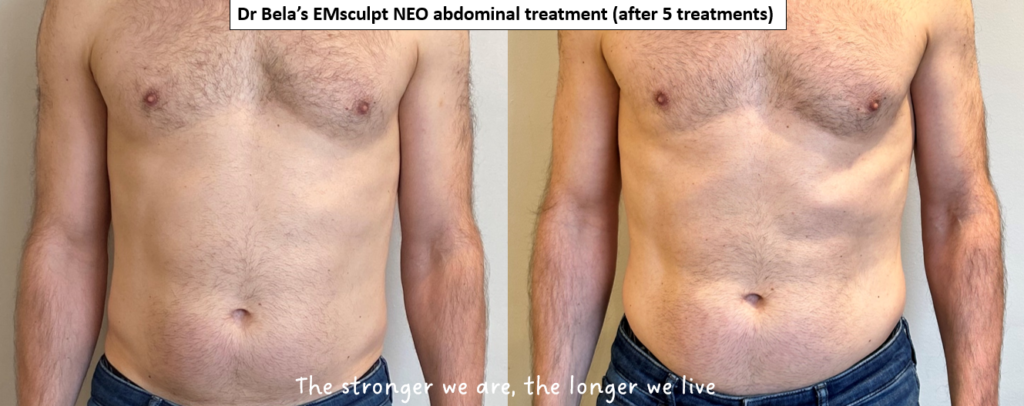 My own EMsculpt NEO before-after - Dr Bela