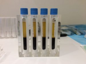 platelet rich plasma