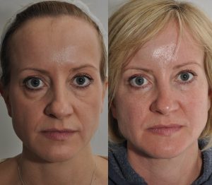 Female dermal filler before after