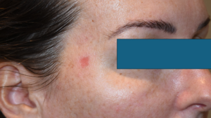 actinic keratosis for Daylight Photodynamic Therapy - Dr Bela Clinic