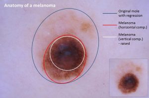 Anatomy of a melanoma - Dr Bela