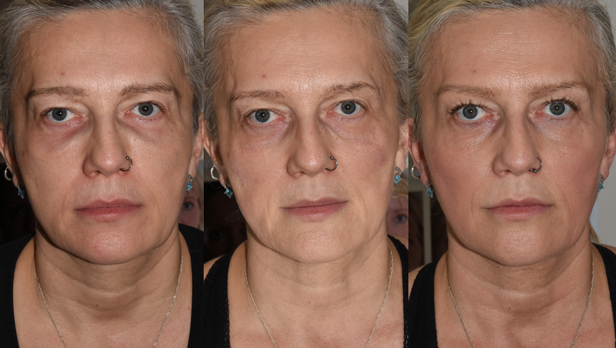 From Botched To Beautiful The Journey Of A Filler Patient Dr Bela