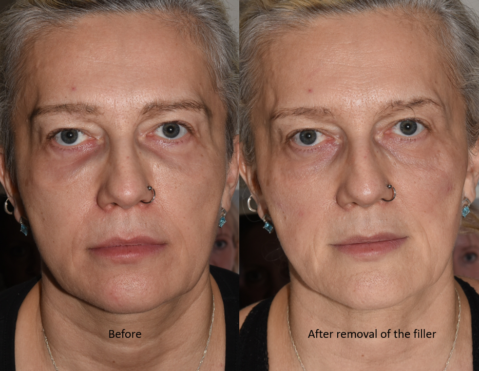 Filler before-after hyalase treatment