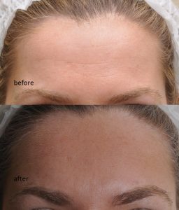 Botox injections forehead Dr Bela Clinic West London