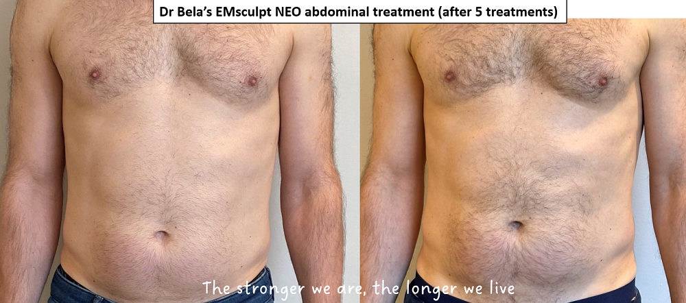 EmSculpt for Mommy Tummy - Cosmetic Dermatology Center