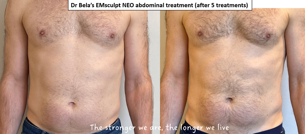 Emsculpt Neo Treatment