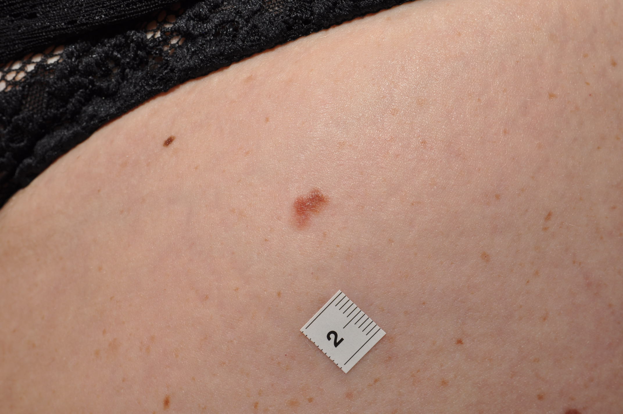 invasive melanoma - Dr Bela