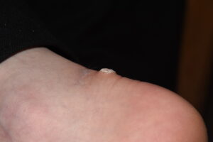 A viral wart on the heel. Removal is necessary.