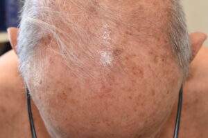 actinic keratosis