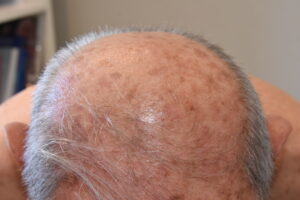 actinic keratosis