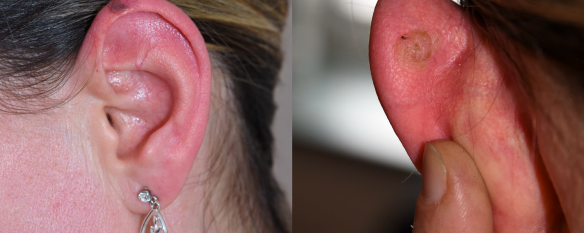 melanoma and keratosis on the ear