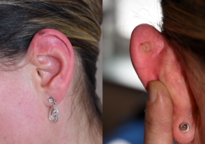 melanoma and keratosis on the ear