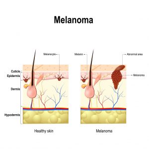 Melanoma - Dr Bela